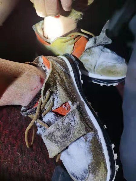 孙某脚踝部被冻破